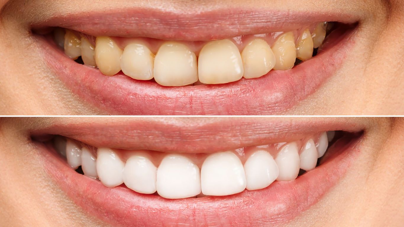 Yellow Teeth