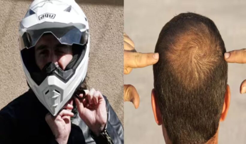 Helmets-Hair loss