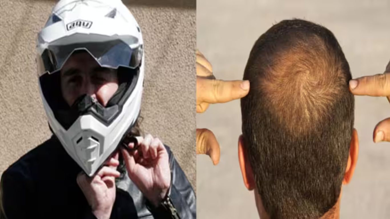 Helmets-Hair loss