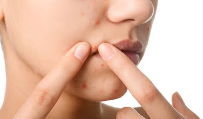 Side Effects Of Removing Acne