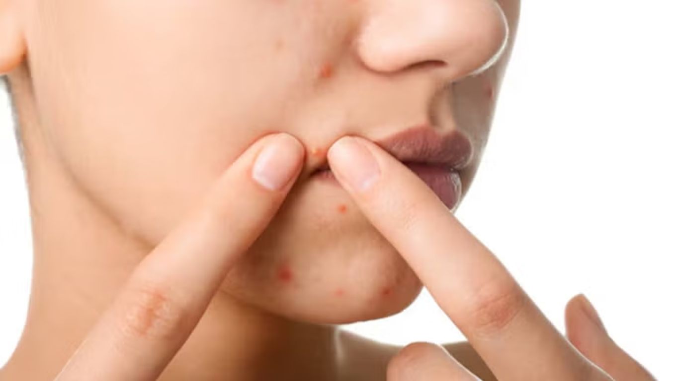 Side Effects Of Removing Acne
