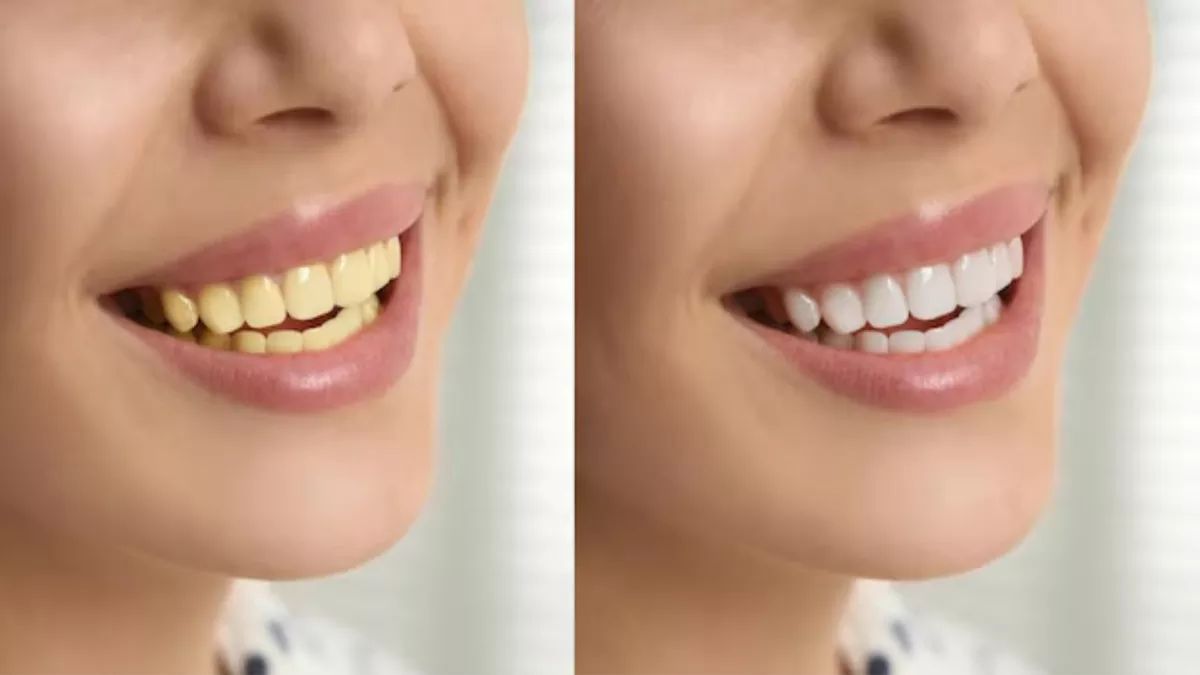 Yellow Teeth