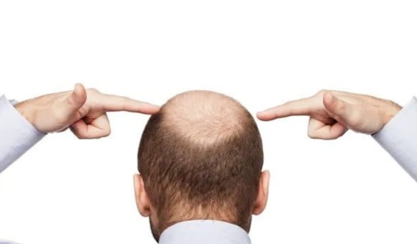 Bald Head In Small Age