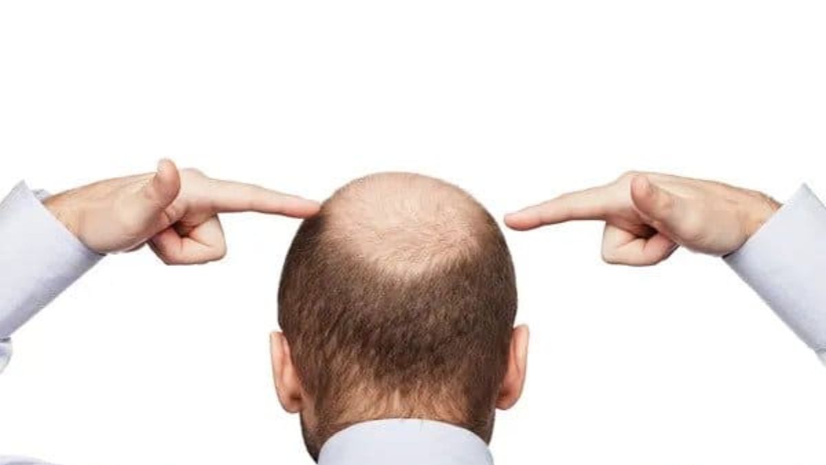 Bald Head In Small Age