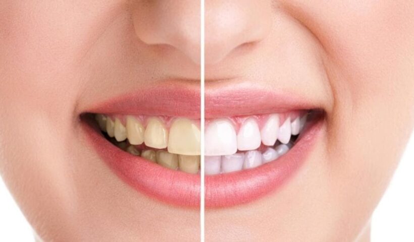 Teeth Tips