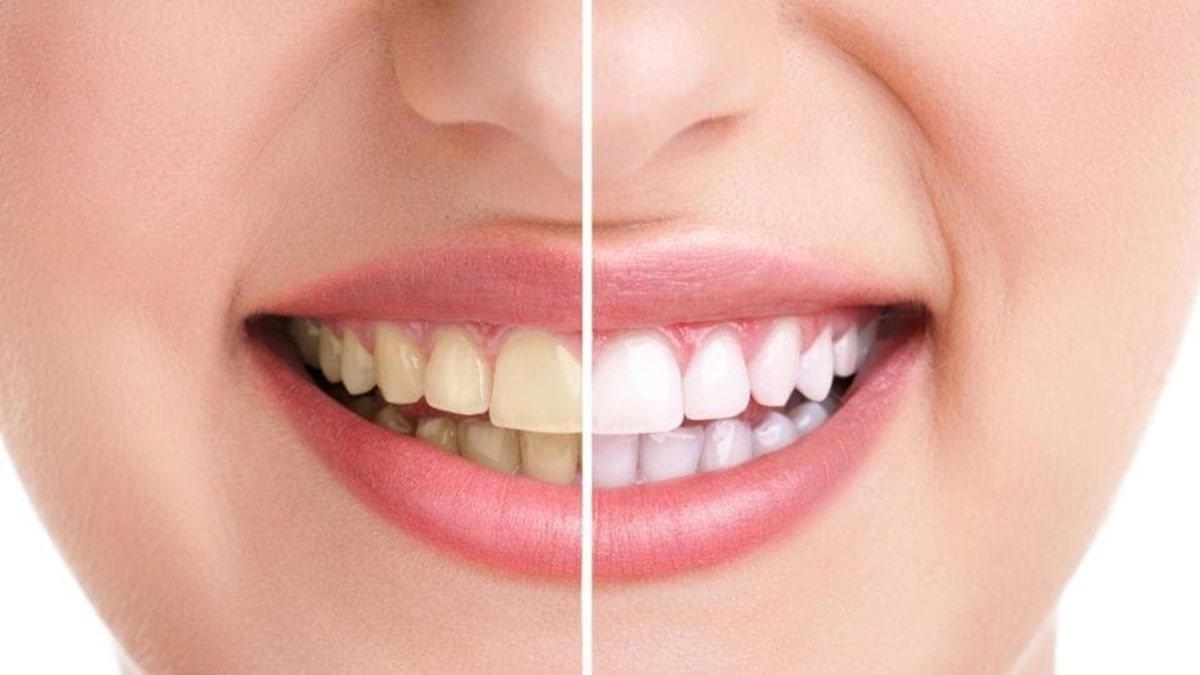Teeth Tips