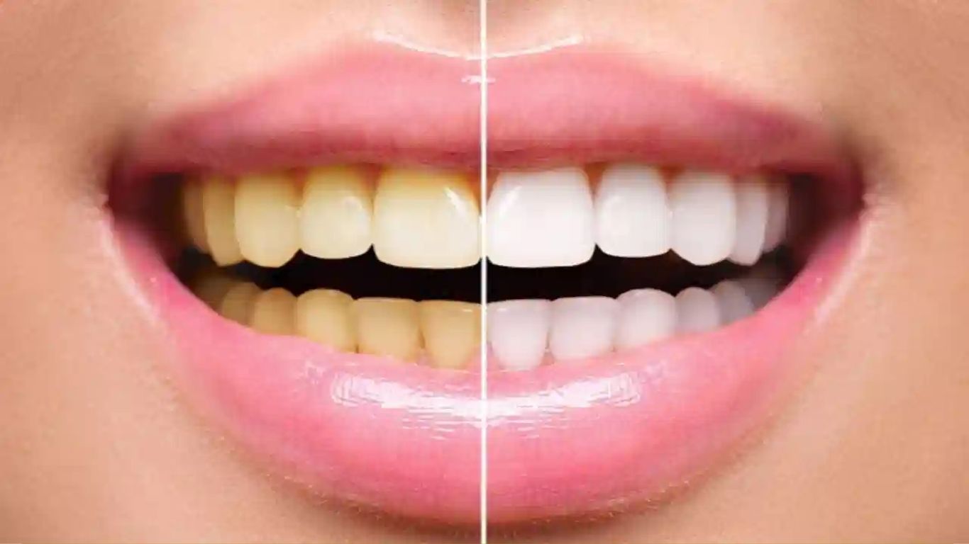 Yellow Teeth