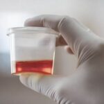 Blood In Urine