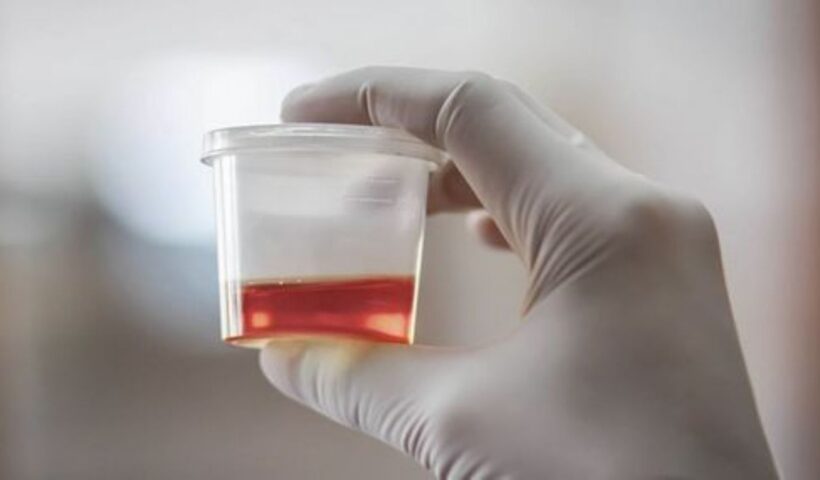 Blood In Urine