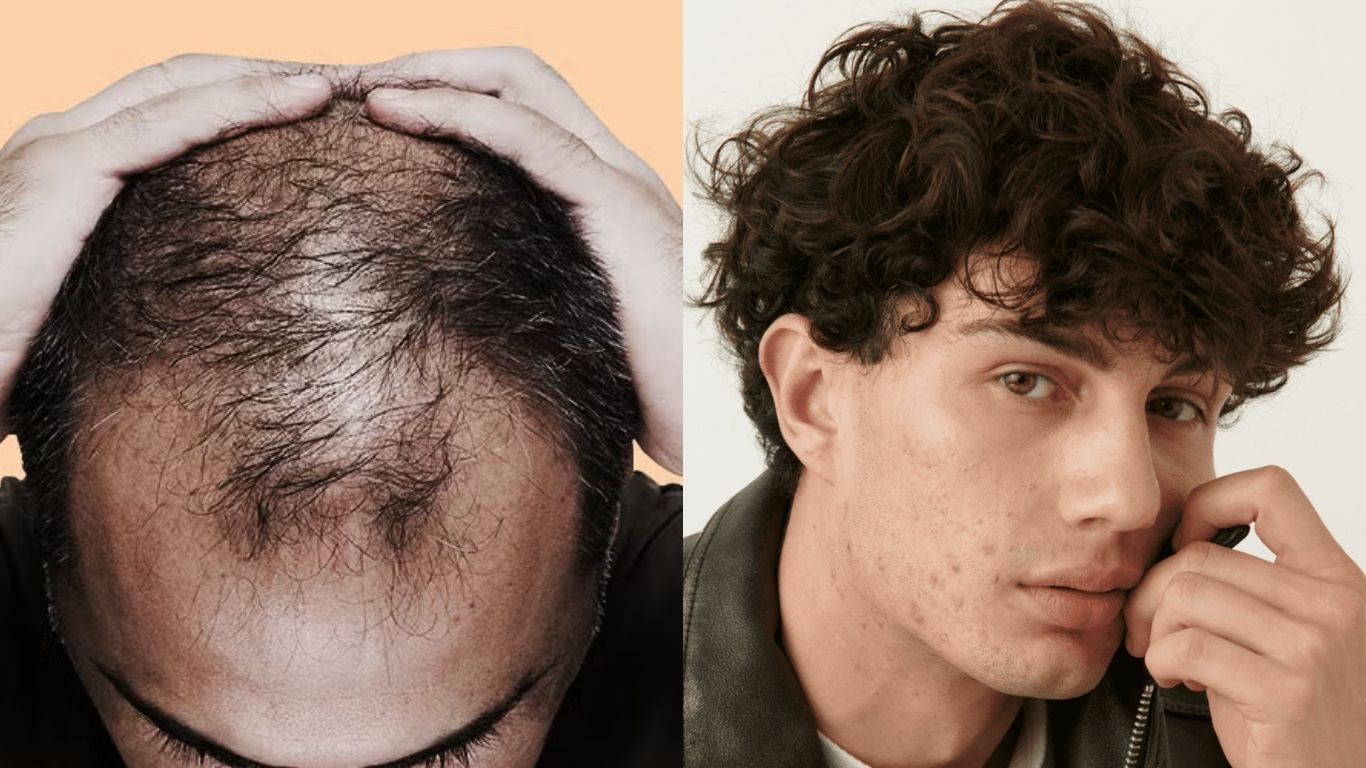 Hair Fall Problem