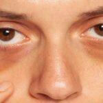 Dark Circles