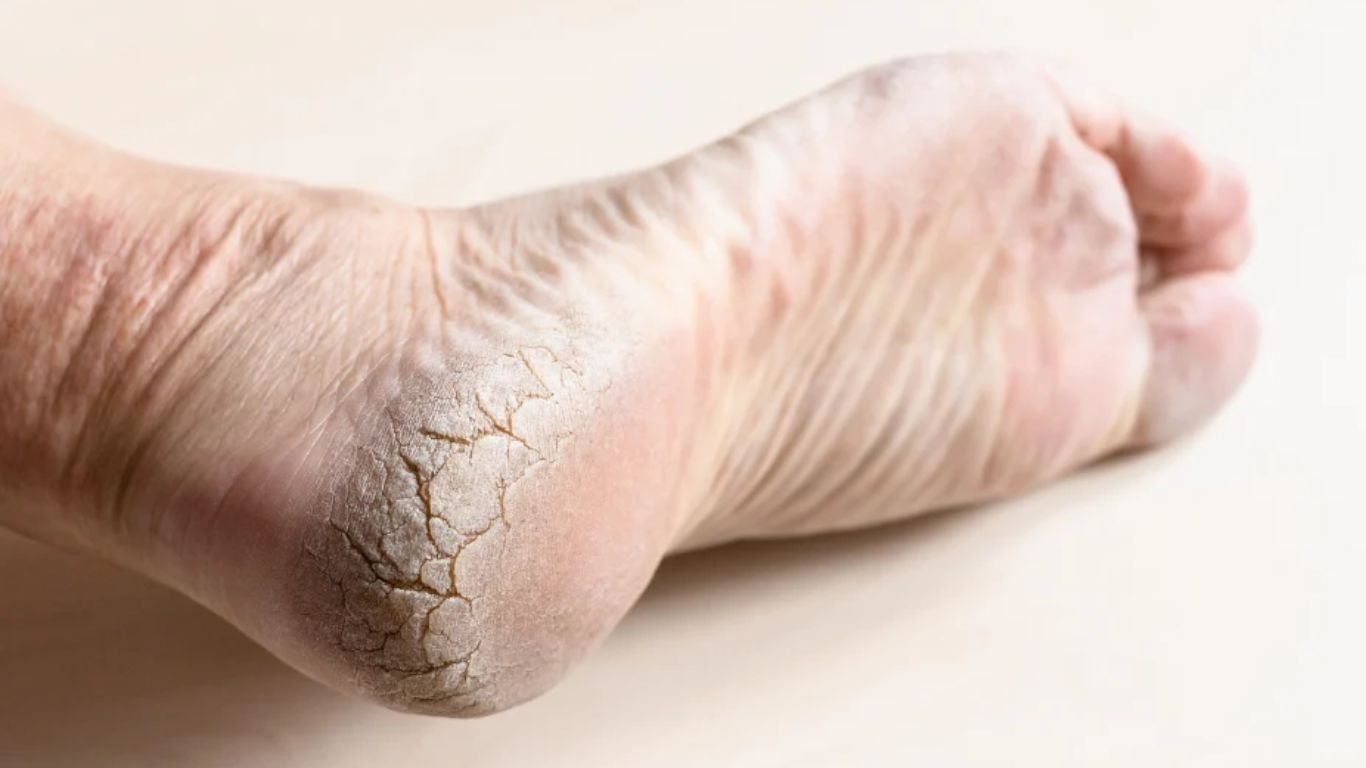Cracked Heels