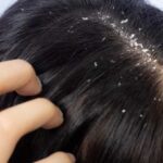 Dandruff Remedies