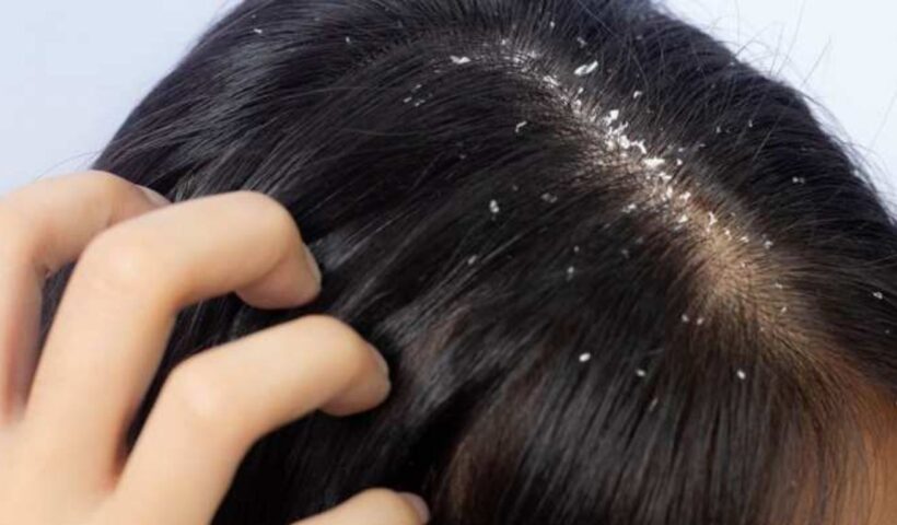Dandruff Remedies