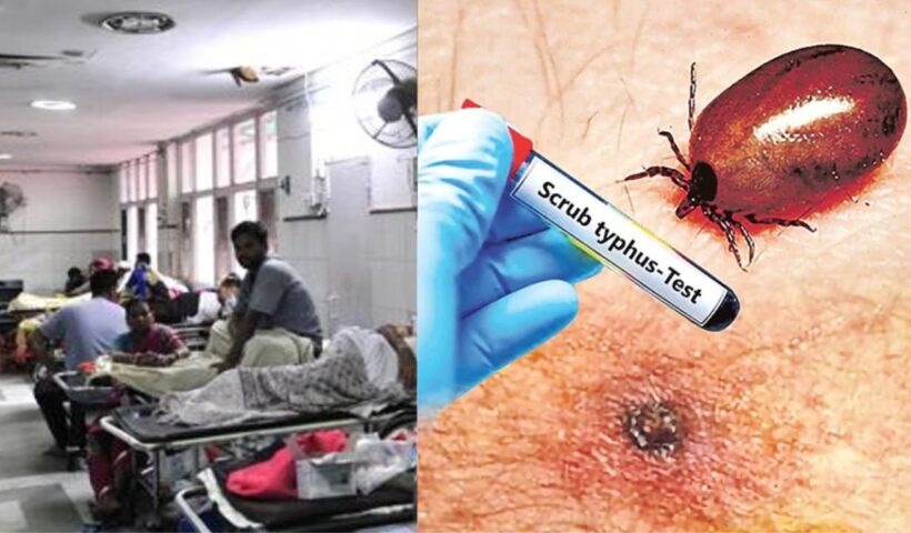 Scrub Typhus