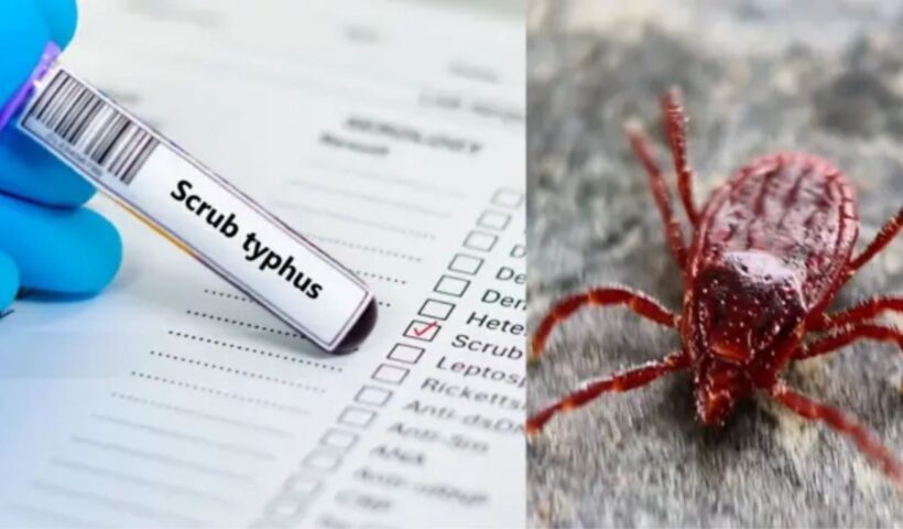 Scrub Typhus