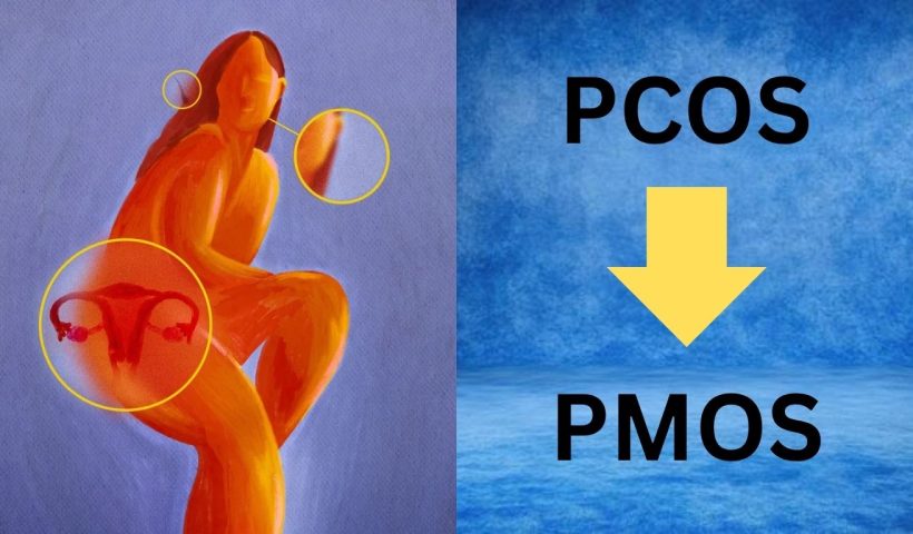 PCOS
